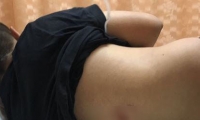 إصابة فتى (14 عامًا) بعد تعرضه لرصاصة طائشة