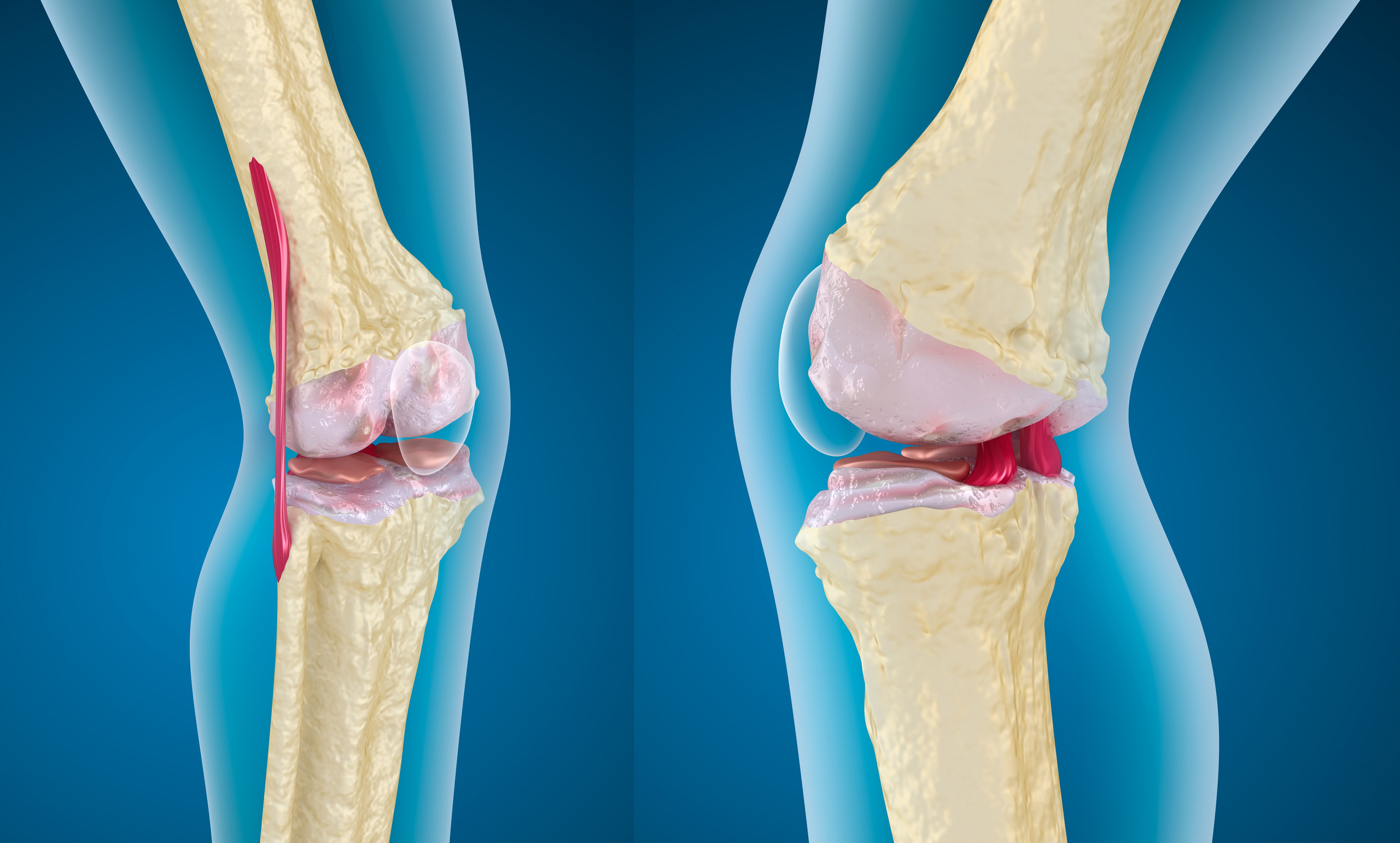 متى تكون الجراحة الحل الأمثل لعلاج تمزق الركبة؟