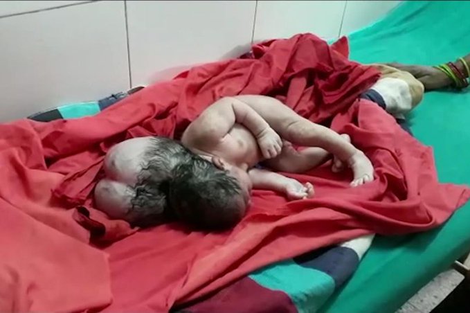 ولادة طفلة بـثلاثة رؤوس تذهل الأطباء في الهند